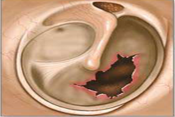 鼓膜穿孔是否構(gòu)成輕傷？